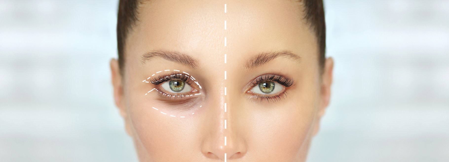 Eyelid surgery/Blepharoplasty,plastic surgeon,before and after